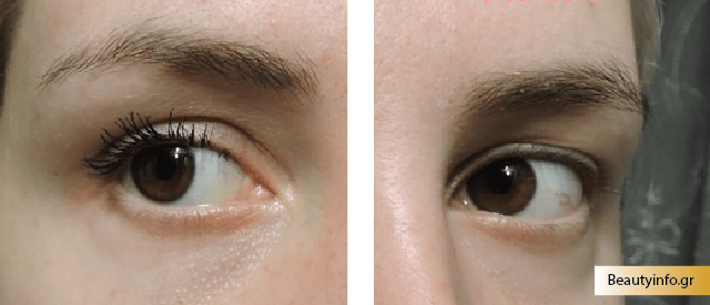 Στις δύο φωτογραφίες βλέπουμε τη διαφορά - το ένα μάτι άβαφτο και το άλλο βαμμένο